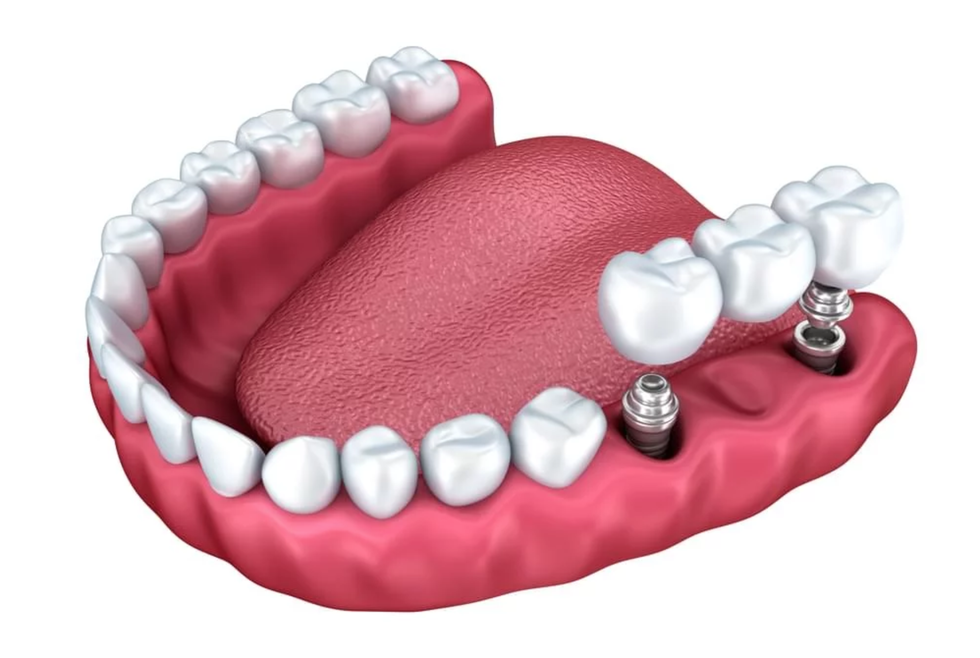 Dental Implants